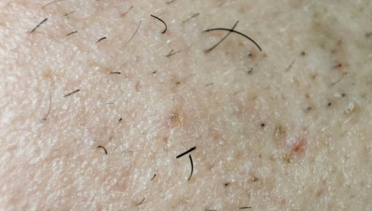 Ingrown Hair and Bumps